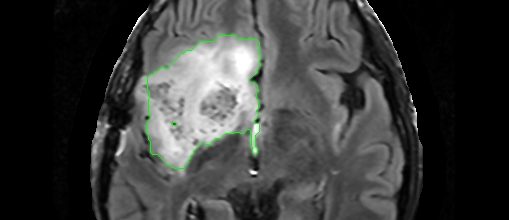 brain tumor segmentation thesis Automatic segmentation of brain structures for radiotherapy planning by pallavi v joshi thesis (tumor) as well as of the structures. brain tumor segmentation thesis Automatic segmentation of brain structures for radiotherapy planning by pallavi v joshi thesis (tumor) as well as of the structures.